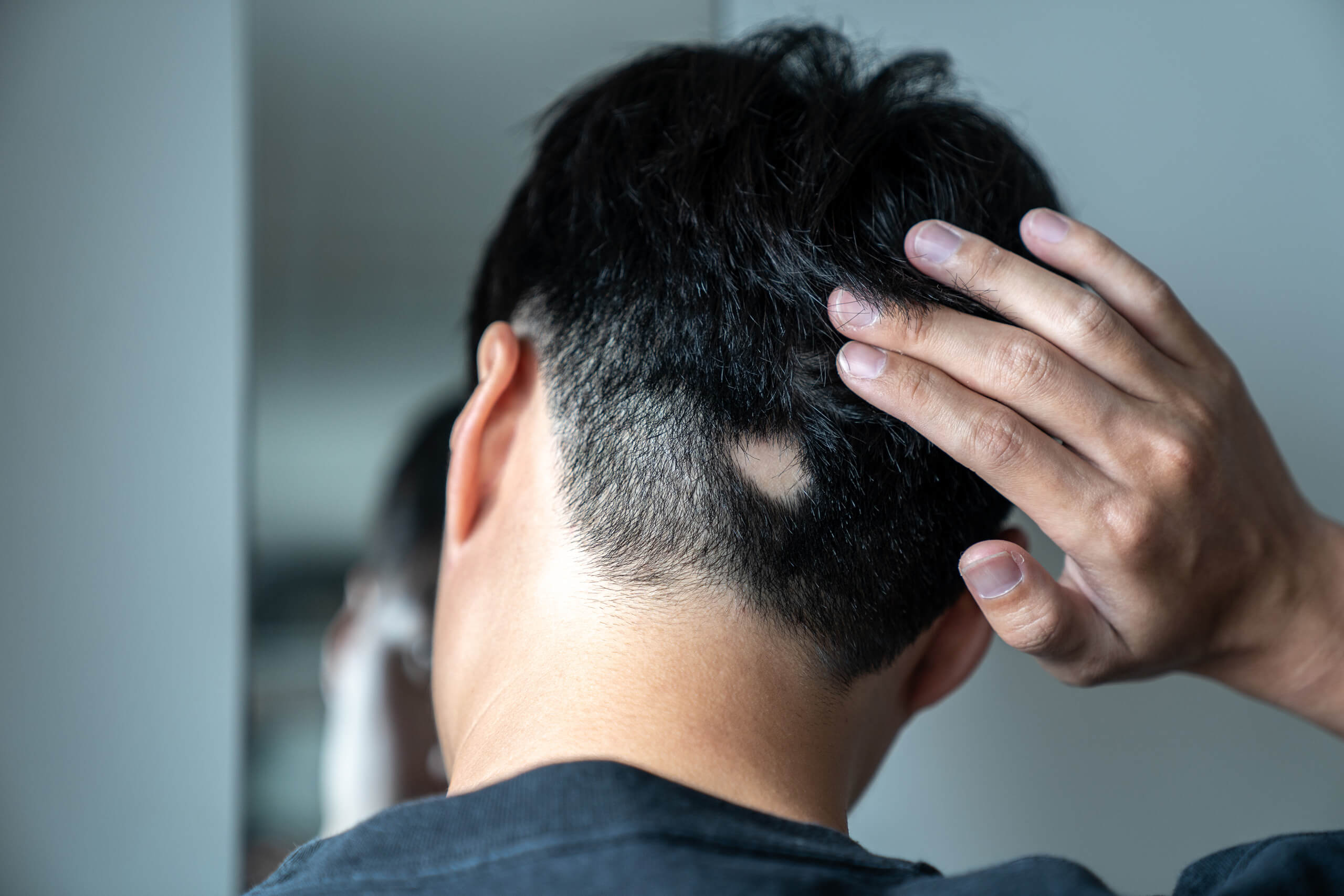 Alopecia areata: Inzicht in de haarziekte