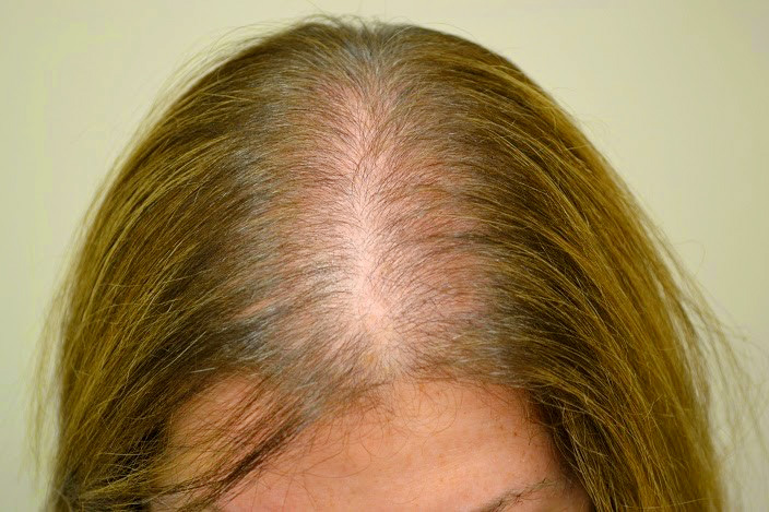 Alopecia androgenetica bij vrouwen: Symptomen en behandeling
