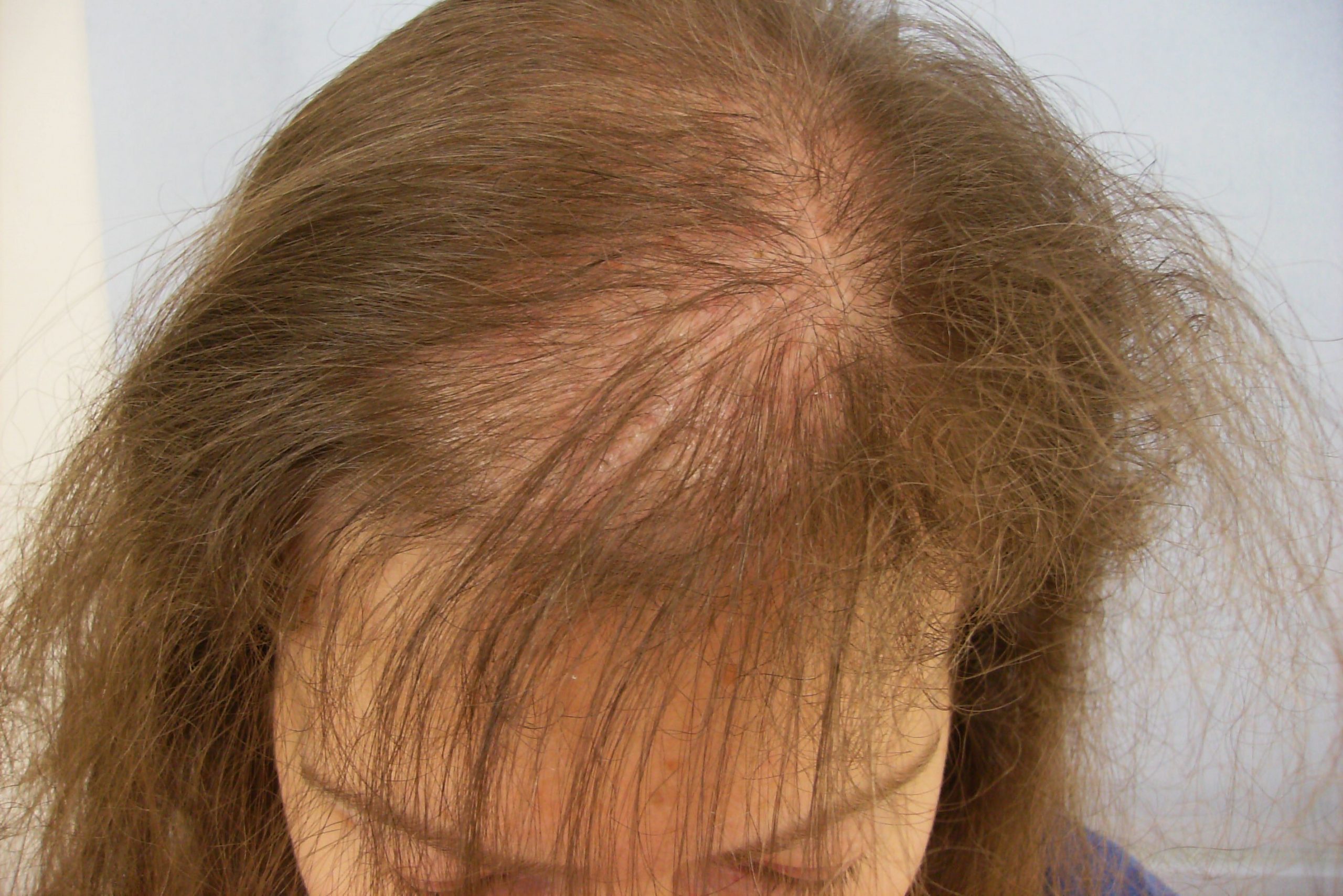 Alopecia androgenetica bij vrouwen: Een veelvoorkomende vorm van haaruitval