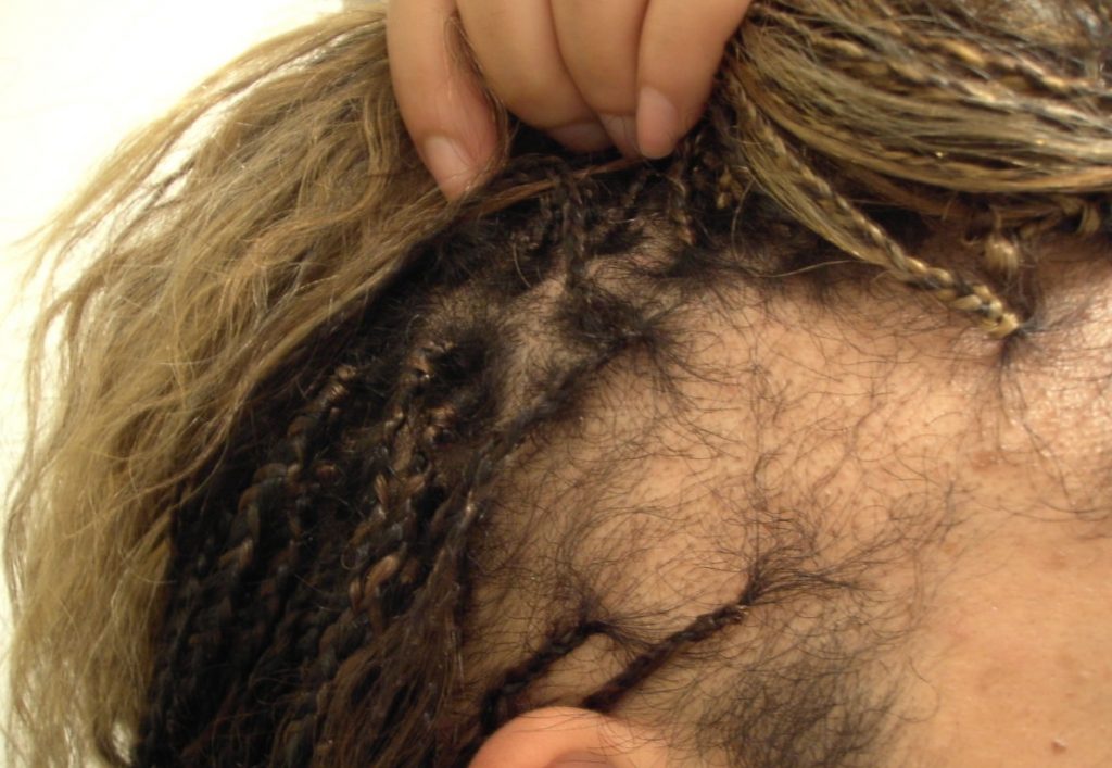 Tractie alopecia: Haarverlies door trekkracht