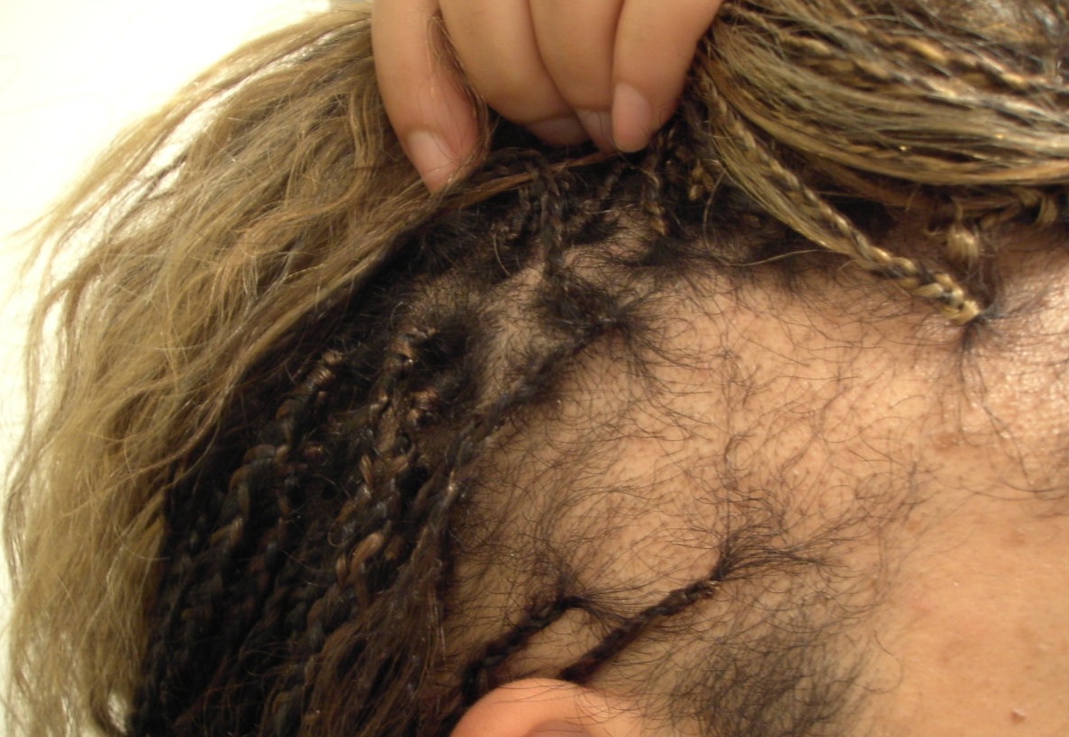 Alopecia symptomen: Herkenning en behandeling